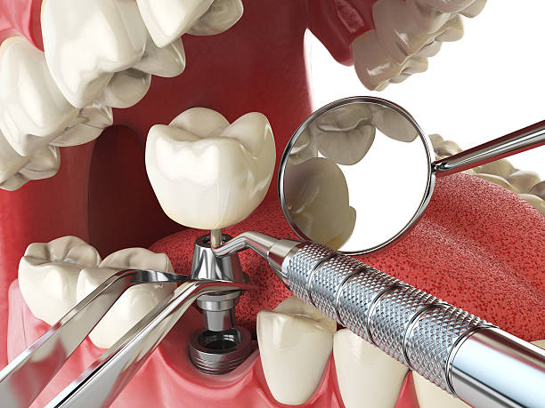 Best Knocked-Out Tooth (Avulsed Tooth) Treatment in Willow Grove, PA